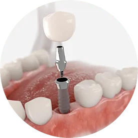 Dental Implants