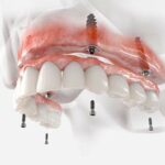 Implant Supported Dentures