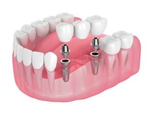 Implant Supported Dentures for missing teeth