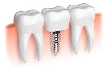 Are Dental Implants Safe?