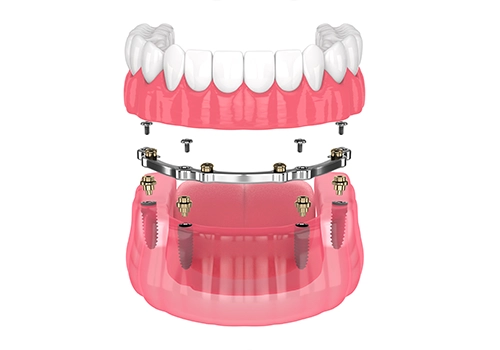 How much do Denture implants cost?