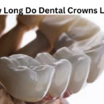 How Long Do Dental Crowns Last?