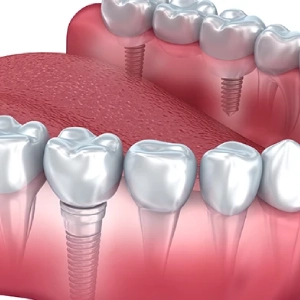 Does Medicare Insurance Cover Dental Implants?