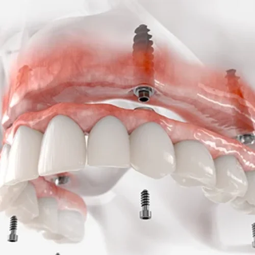 All-on-4-Dental-Implant-Procedure-02 All-on-4-Dental-Implant-Procedure-02