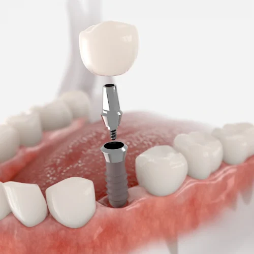 How to Clean Dentures? How to Clean Dentures?